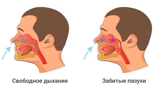 Закладеність носа без нежиті яке потрібне лікування якщо закладений ніс а нежитю немає