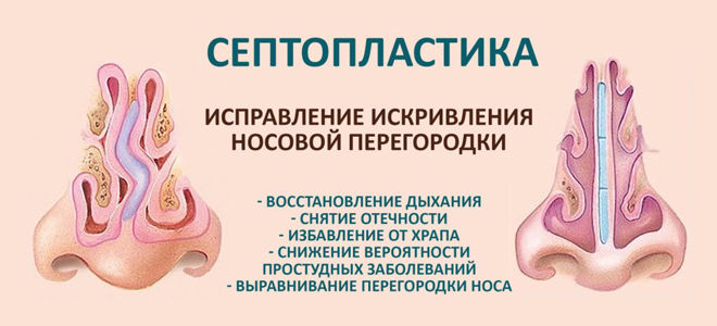 Закладеність носа без нежиті яке потрібне лікування якщо закладений ніс а нежитю немає
