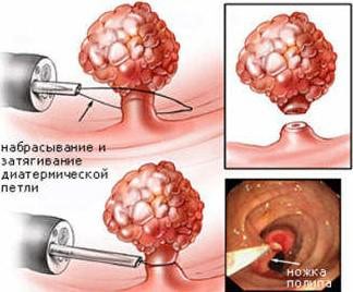 Закладеність носа лікуємо нежить