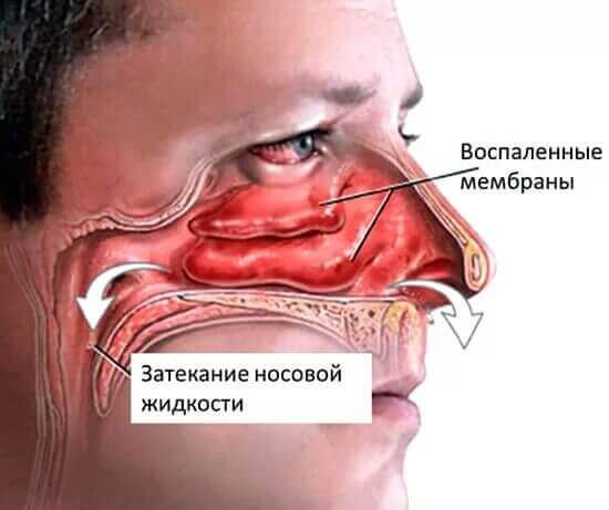 Закладений ніс краплі не допомагають: що робити для лікування