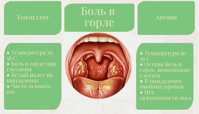 Заклало горло (що робити, які причини викликають). Причини закладеності в горлі і основні підходи до лікування