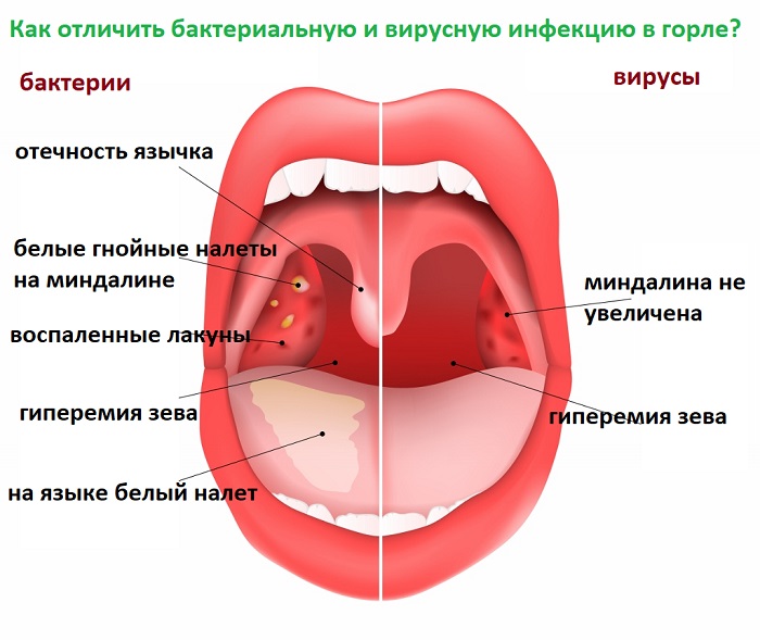 Заклало горло (що робити, які причини викликають). Причини закладеності в горлі і основні підходи до лікування
