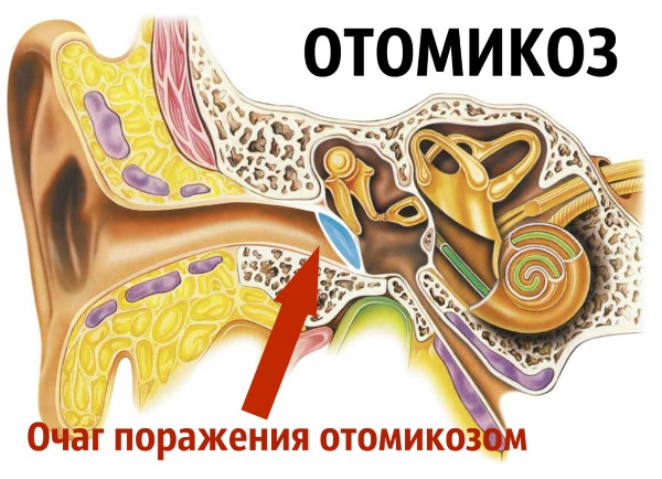 закопувати борну кислоту в вухо дорослим. Як лікувати отит у дітей і дорослих борною кислотою