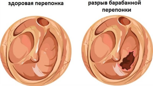 закопувати борну кислоту в вухо дорослим. Як лікувати отит у дітей і дорослих борною кислотою