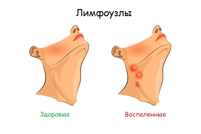 Запальний процес в лімфатичному вузлі за вухом лімфаденіт
