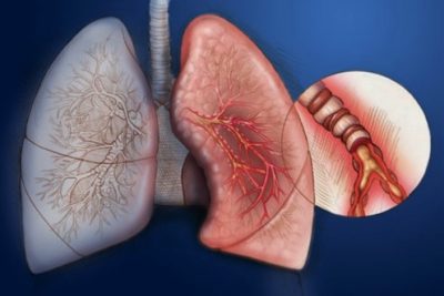 Запалення бронхів легенів симптоми – Лікування простудних захворювань