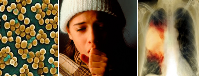 Запалення легень – симптоми у дітей та ознаки пневмонії у дитини