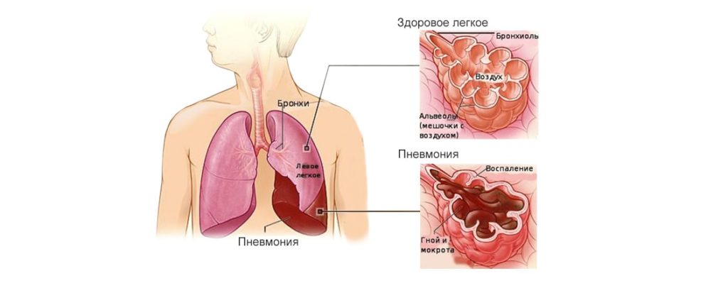 Запалення легенів без температури причини симптоми і лікування