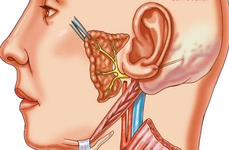 Запалення слухового нерва симптоми і лікування