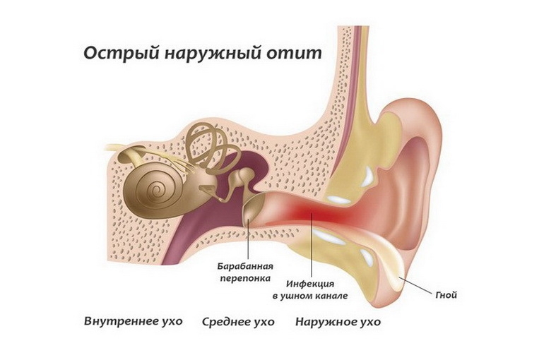 Запалення зовнішнього слухового проходу. Симптоми і лікування запалення слухового проходу