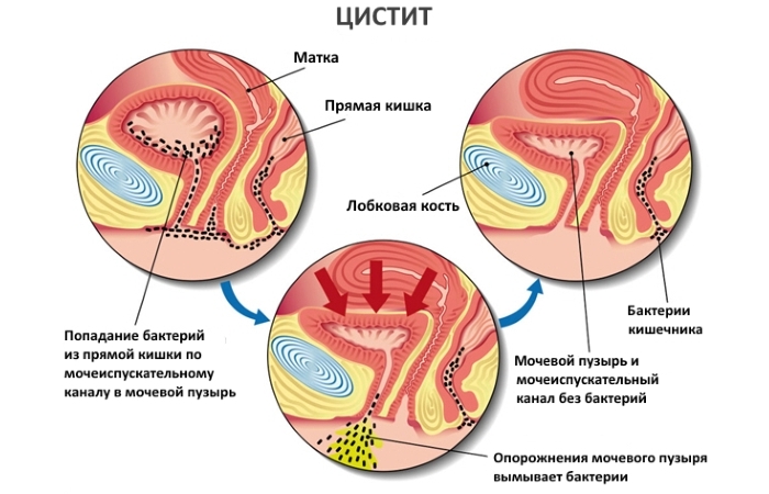 Застосування Монуреля для лікування сечостатевої системи