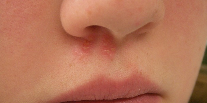 Застуда в носі — чим лікувати, мазь від застуди в носі. Чим лікувати нежить в носі: сучасні методи терапії герпесу
