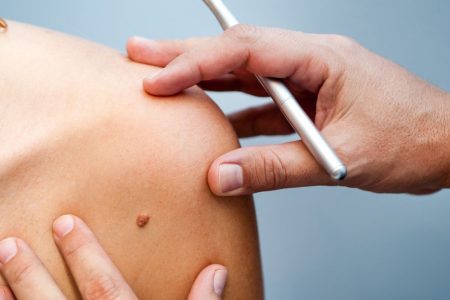 удаление папиллом и родинок